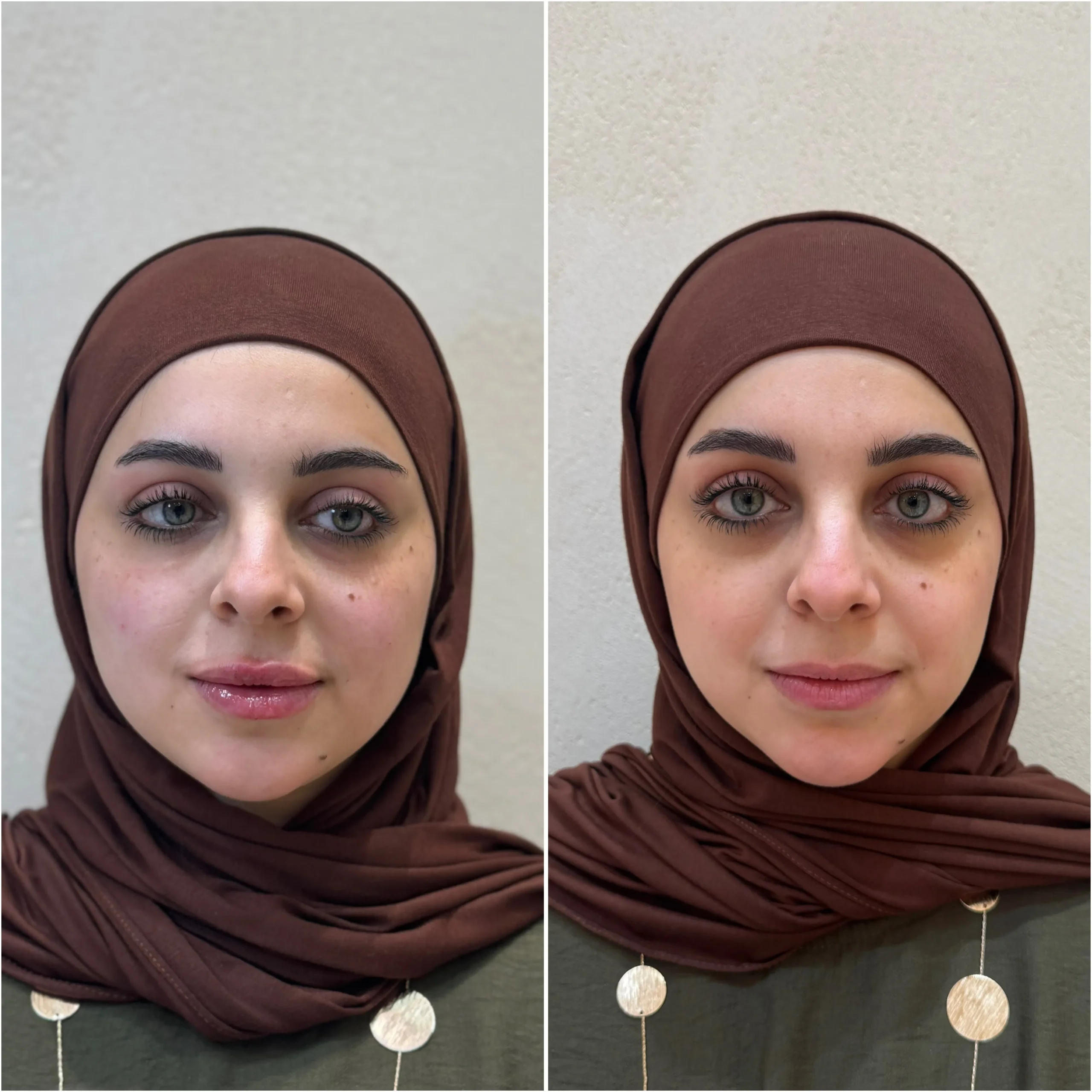 ابرة دبي قبل وبعد