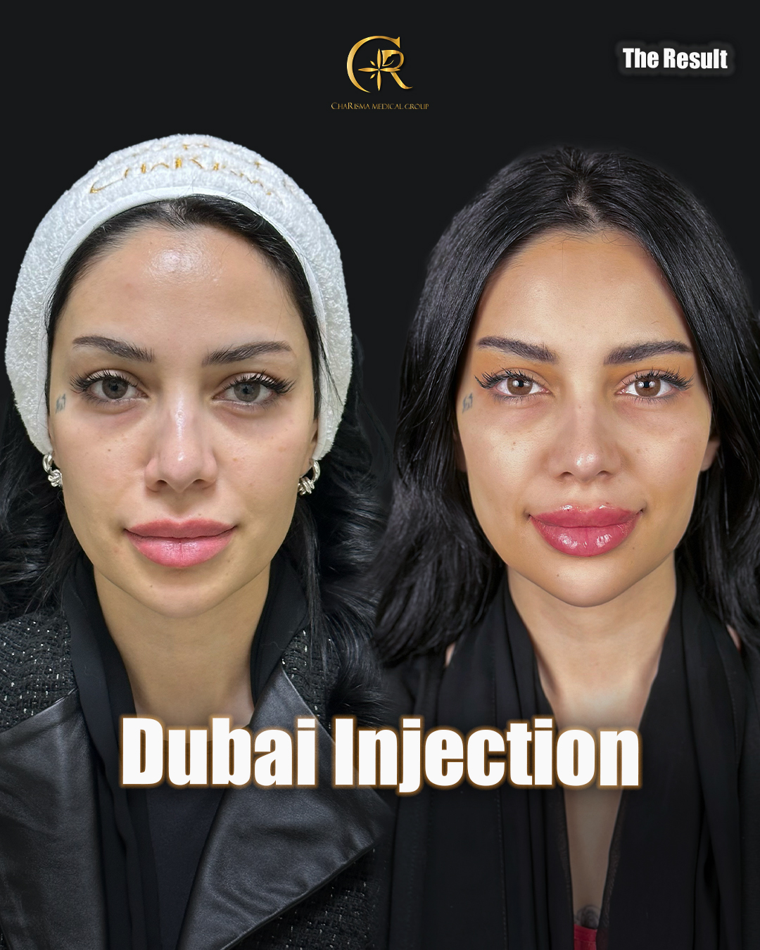 Dubai injection treatment before and after