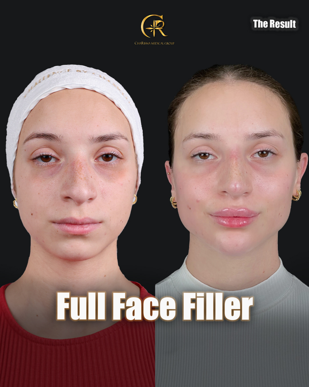 Full face filler treatment before and after