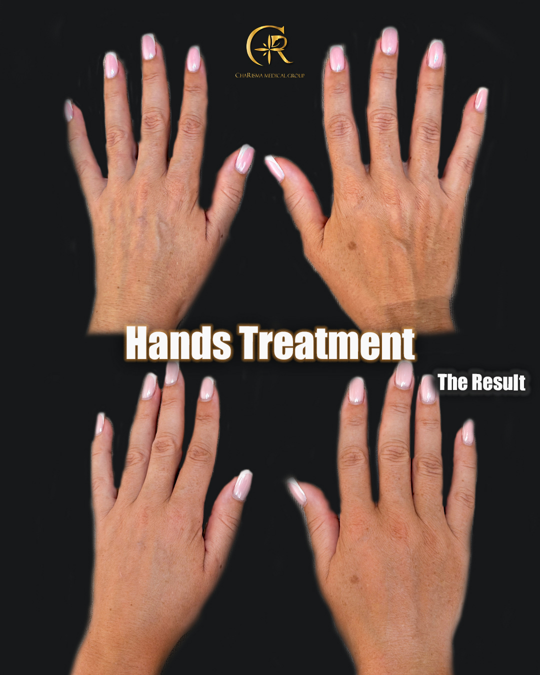 Hand rejuvenation treatment before and after
