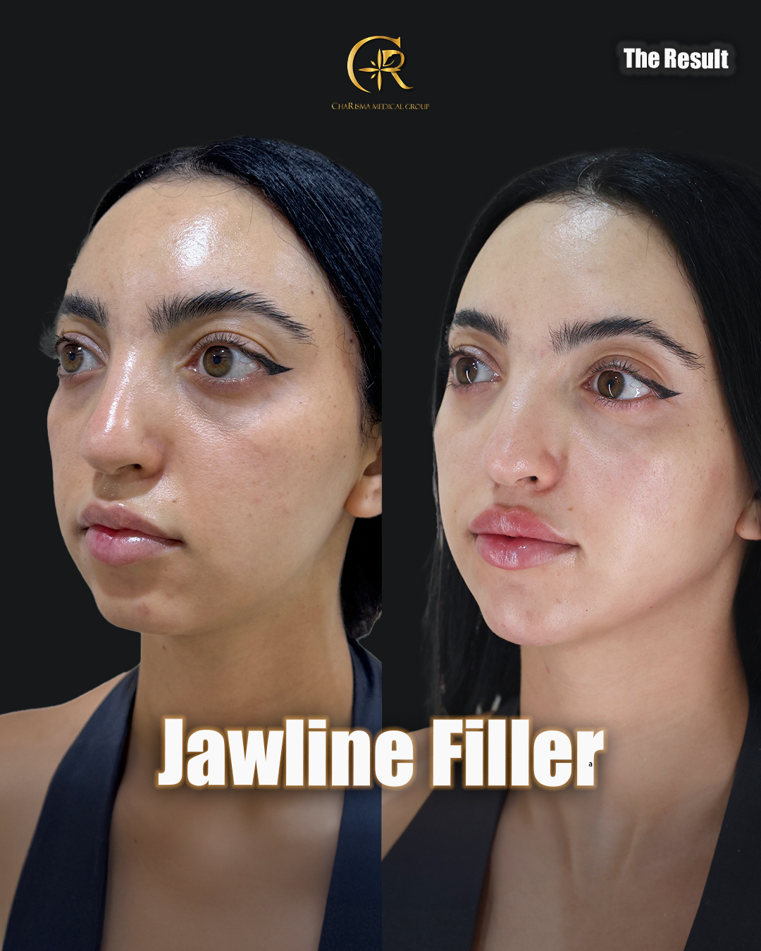 Jawline filler treatment before and after