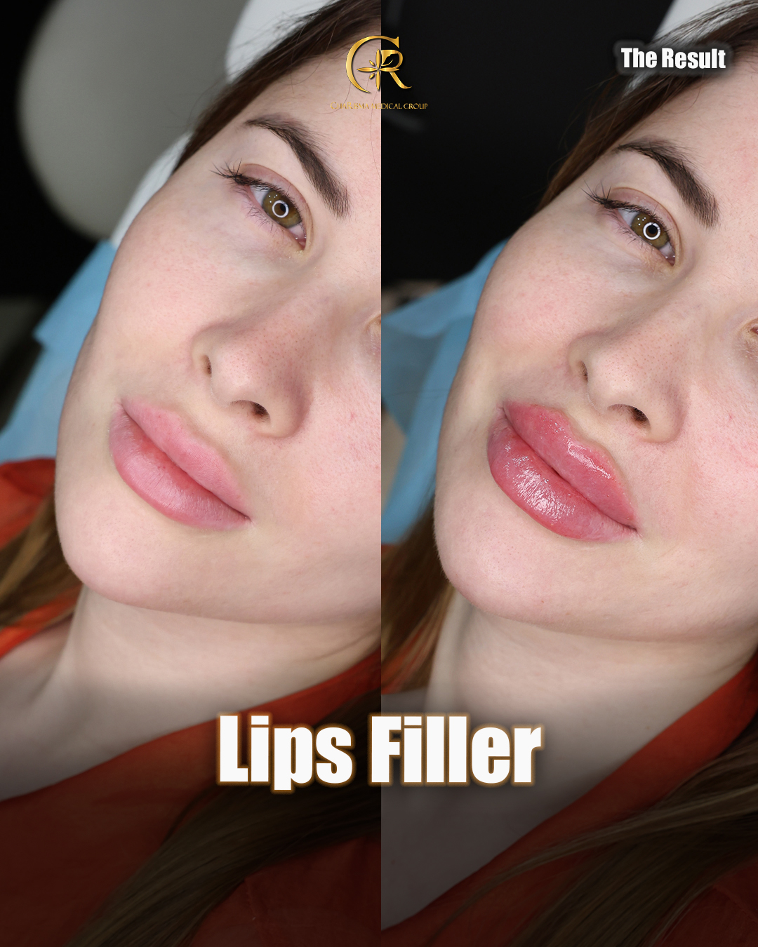 Lip filler treatment before and after
