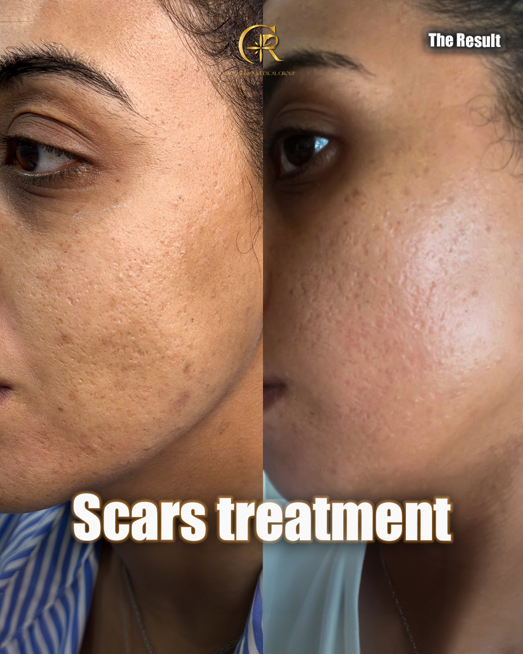 Scar treatment before and after
