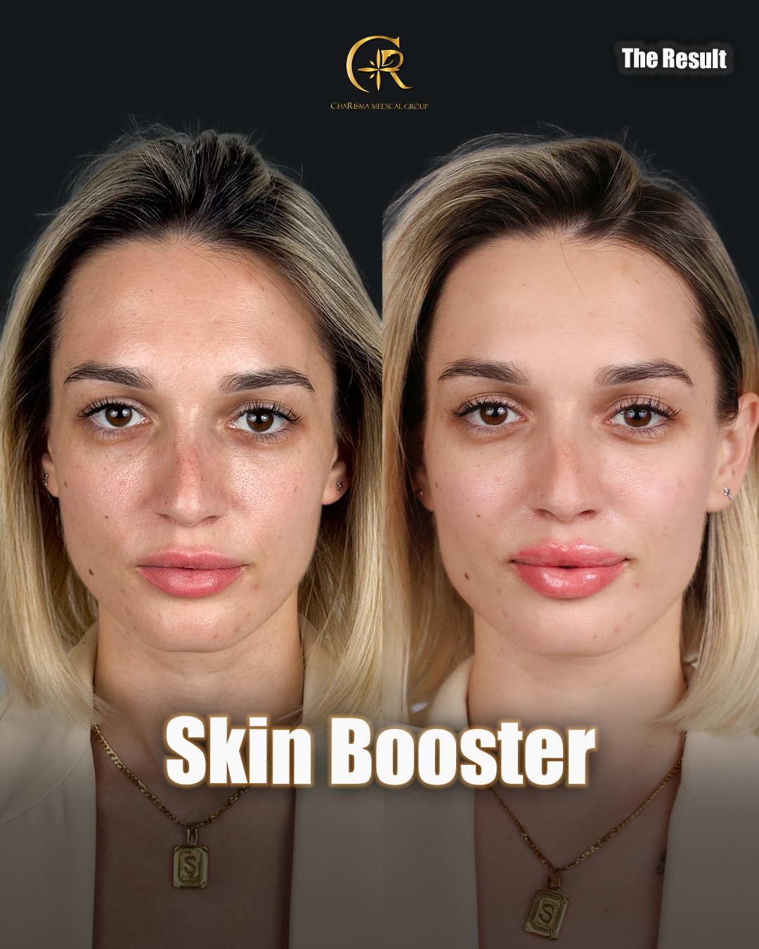 Skin booster treatment before and after