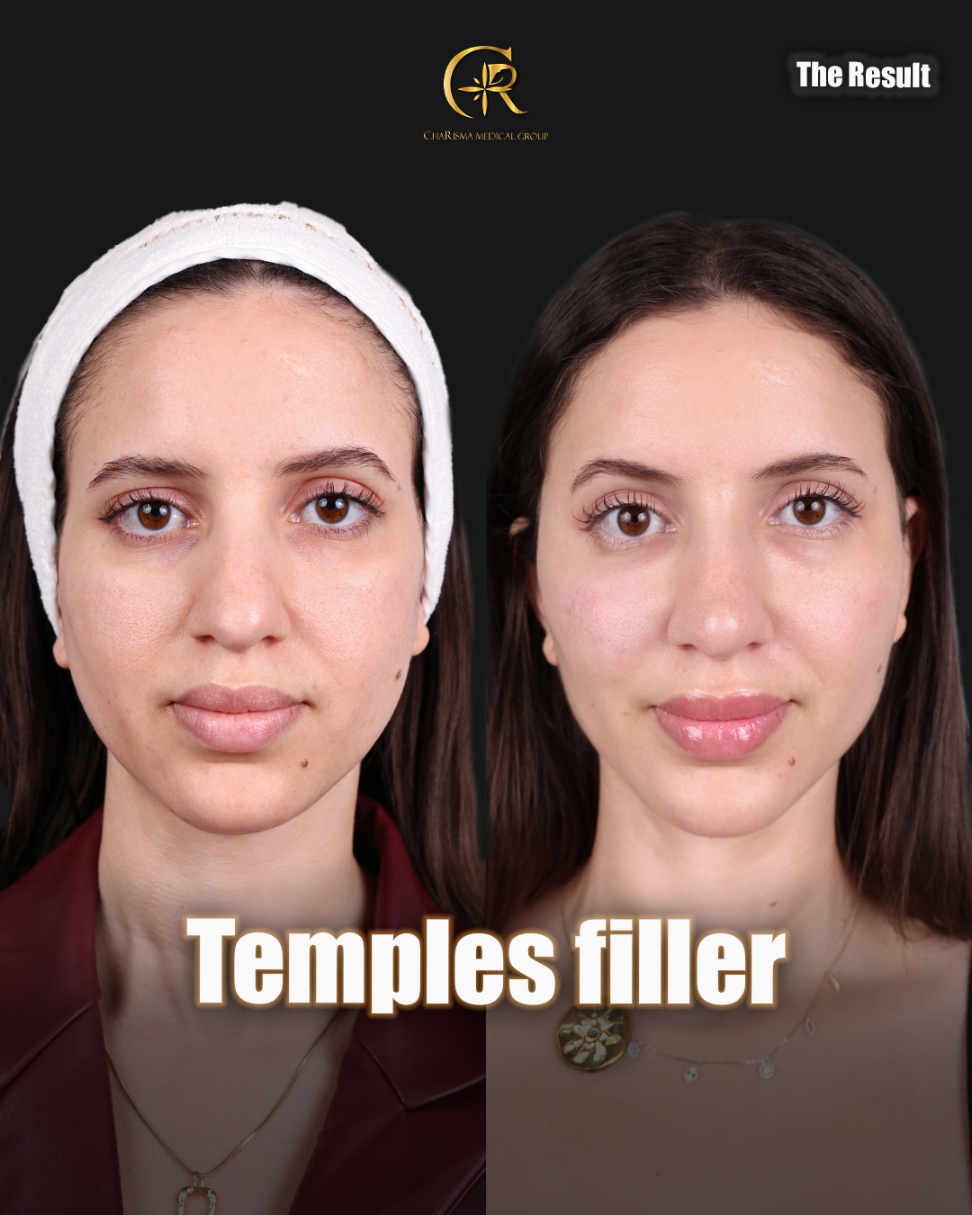 Temple filler treatment before and after