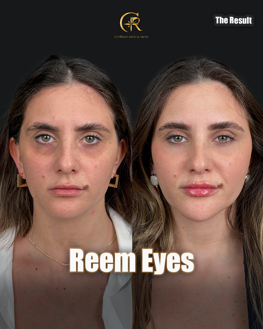 Eye rejuvenation treatment before and after