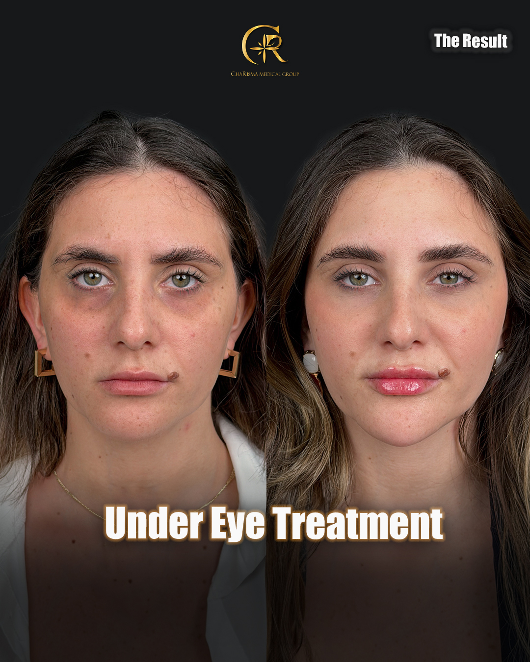 Under eye treatment before and after