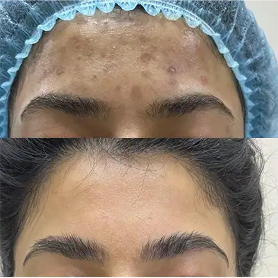 Acne-Scars.webp