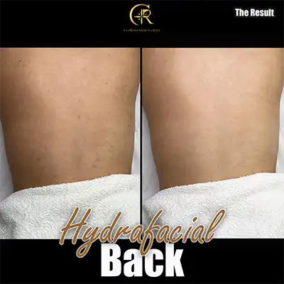 Back-Hydrafacial-1.webp
