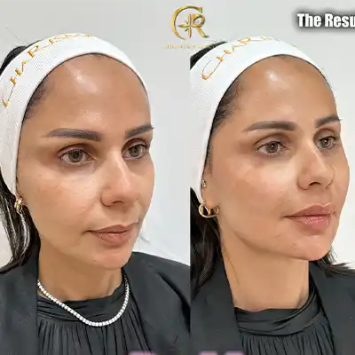 Barbie-treatment-1.webp