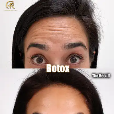 Botox1.webp