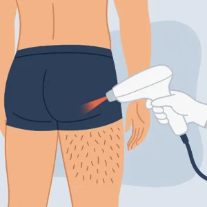 Laser Buttocks Hair Removal for Men in Dubai