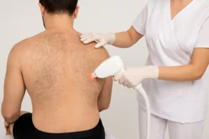 Laser Hair Removal Full Back (Without Buttocks) for Men