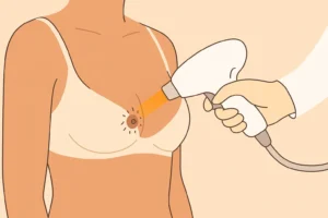 Laser Nipples Hair Removal for Women in Dubai