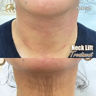 Neck-Lift.webp