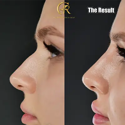 Nose-Filler.webp